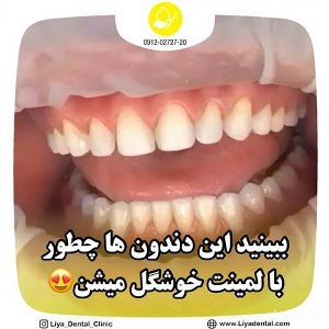 لمینت دندان راهی برای دندان‌های زیبا و جذاب + فیلم