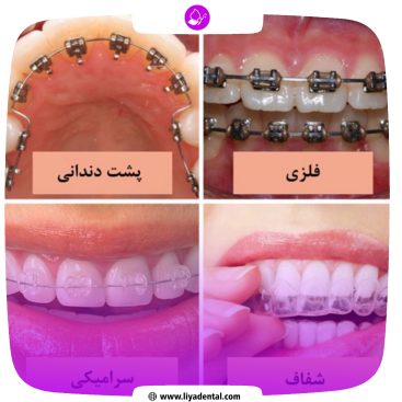 نمونه کار ارتودنسی کلینیک دندانپزشکی لیادنتال